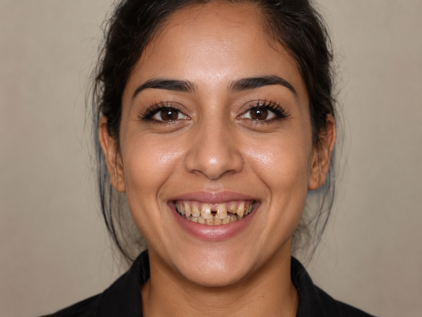Veneers — before treatment